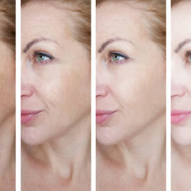 female eye wrinkles before and after treatments