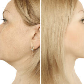 woman double chin lift before and after procedures