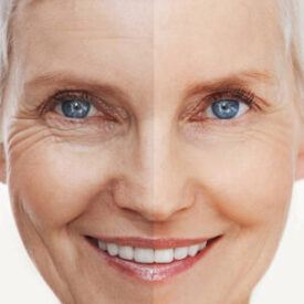 Before and after shot of a beautiful senior woman's facehttp://195.154.178.81/DATA/i_collage/pi/shoots/783435.jpg